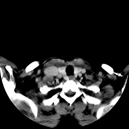 File:Carotid body tumor (Radiopaedia 27890-28124 A 26).jpg