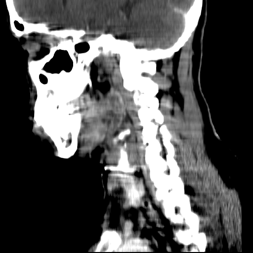 File:Carotid body tumor (Radiopaedia 27890-28124 C 8).jpg