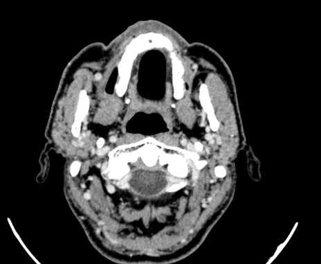 Carotid body tumor (Radiopaedia 61750-69757 Axial Post contrast 9).jpg