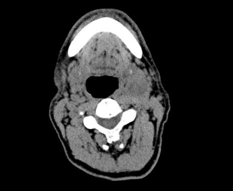 Carotid body tumor (Radiopaedia 61750-69757 Axial non-contrast 43).jpg