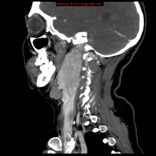 Carotid body tumor with lung metastases (Radiopaedia 9301-9986 Sagittal C+ delayed 36).jpg