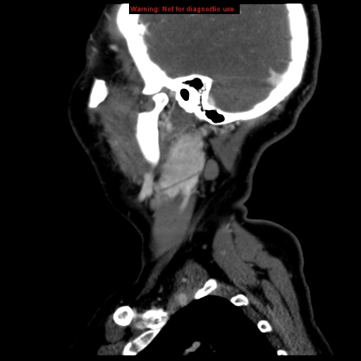 Carotid body tumor with lung metastases (Radiopaedia 9301-9986 Sagittal C+ delayed 44).jpg