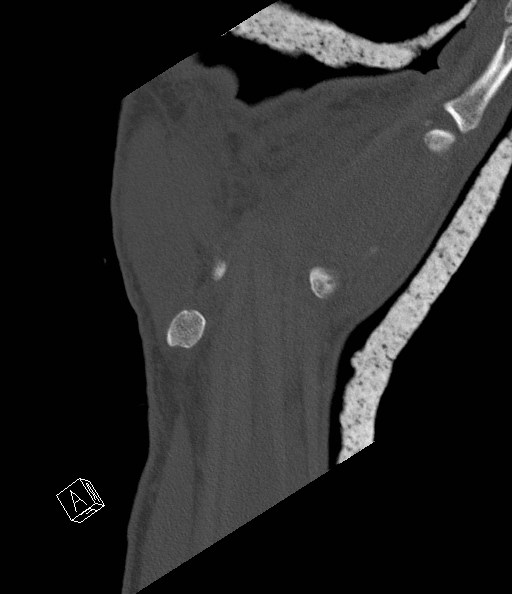 File:Carpal fractures (smart watch impaction) (Radiopaedia 55844-62430 Coronal bone window 23).jpg