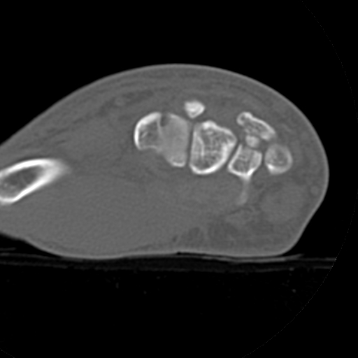 File:Carpo-metacarpal fracture-dislocations with hamatum split fracture (Radiopaedia 18482-18343 Axial bone window 18).jpg