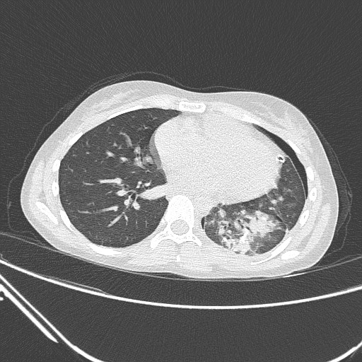 Catamenial pneumothorax (Radiopaedia 27946-28197 lung window 99).jpg