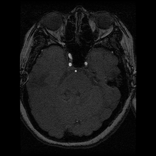 Cavernoma, DVA and right ICA aneurysm (Radiopaedia 33890-35072 E 67).png