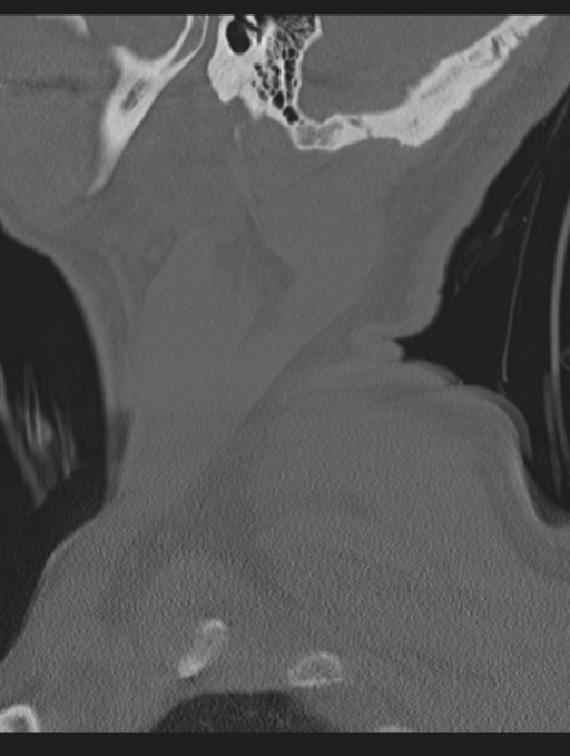 Cavernoma of cervical cord (Radiopaedia 50838-56346 Sagittal bone window 5).png