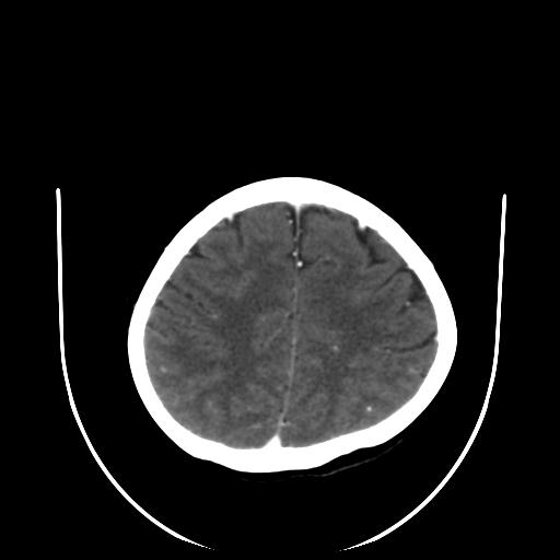 File:Cavernoma with developmental venous anomaly (Radiopaedia 22470-22506 C+ arterial phase 27).jpg