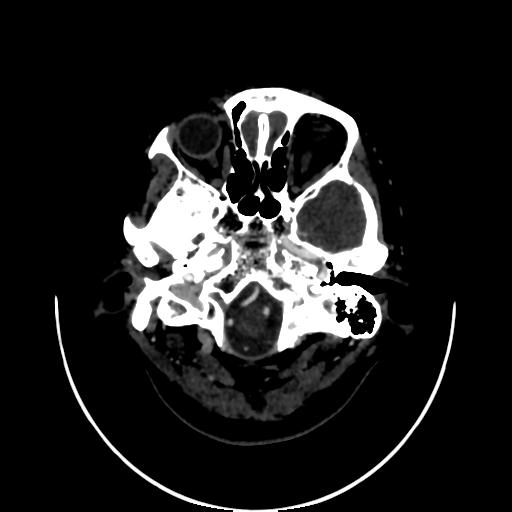 File:Cavernoma with developmental venous anomaly (Radiopaedia 22470-22506 C 9).jpg