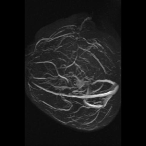 Cavernoma with developmental venous anomaly (Radiopaedia 22470-22507 MRV 13).jpg