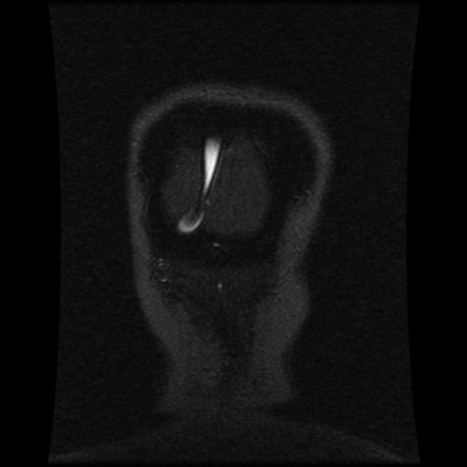 Cavernoma with developmental venous anomaly (Radiopaedia 22470-22507 MRV 26).jpg