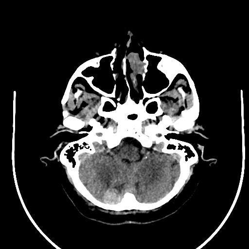 Cavernous hemangioma of the cerebellar falx (Radiopaedia 73025-83723 Axial non-contrast 23).jpg