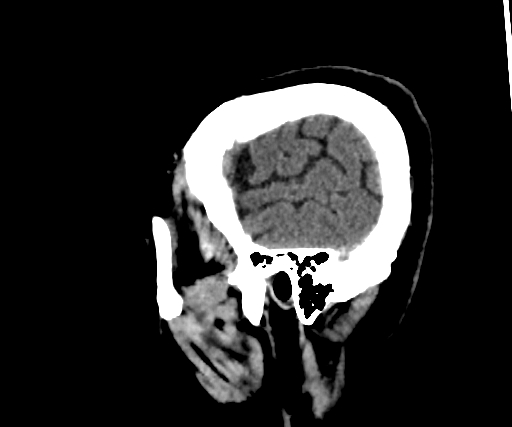 Cavernous hemangioma of the cerebellar falx (Radiopaedia 73025-83723 B 45).jpg