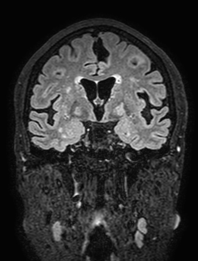 Cavernous hemangioma of the cerebellar falx (Radiopaedia 73025-83724 Coronal FLAIR 157).jpg