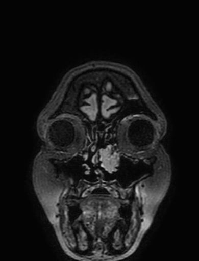 Cavernous hemangioma of the cerebellar falx (Radiopaedia 73025-83724 Coronal FLAIR 16).jpg