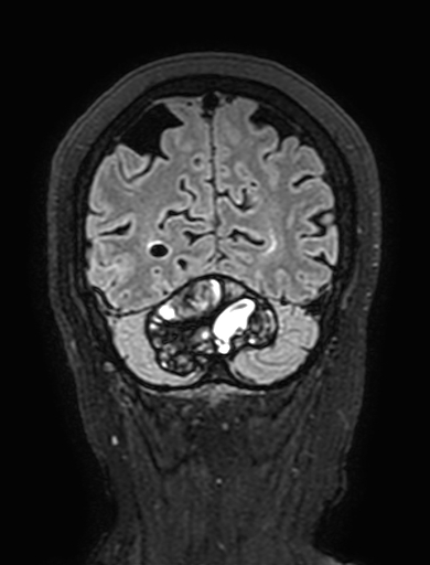 Cavernous hemangioma of the cerebellar falx (Radiopaedia 73025-83724 Coronal FLAIR 294).jpg