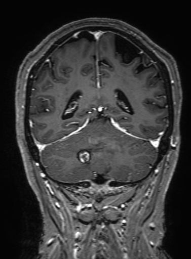 Cavernous hemangioma of the cerebellar falx (Radiopaedia 73025-83724 Coronal T1 C+ 272).jpg