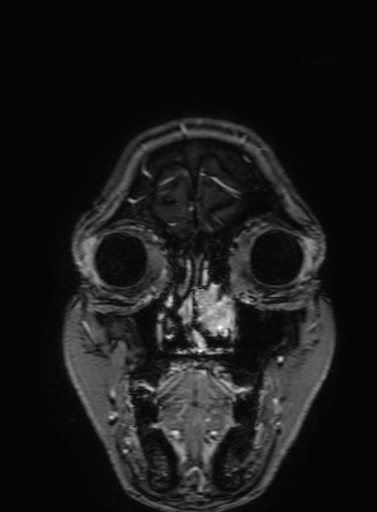 Cavernous hemangioma of the cerebellar falx (Radiopaedia 73025-83724 Coronal T1 C+ 34).jpg