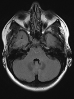 File:Cavernous malformation (cavernous angioma or cavernoma) (Radiopaedia 36675-38237 Axial T2 FLAIR 5).png