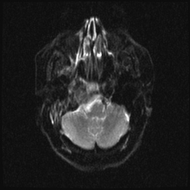 Cavernous sinus meningioma (Radiopaedia 63682-72367 DWI 5).jpg
