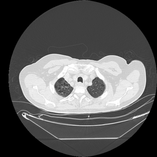 Cavitating bronchogenic carcinoma (Radiopaedia 44489-48162 Axial lung window 6).jpg