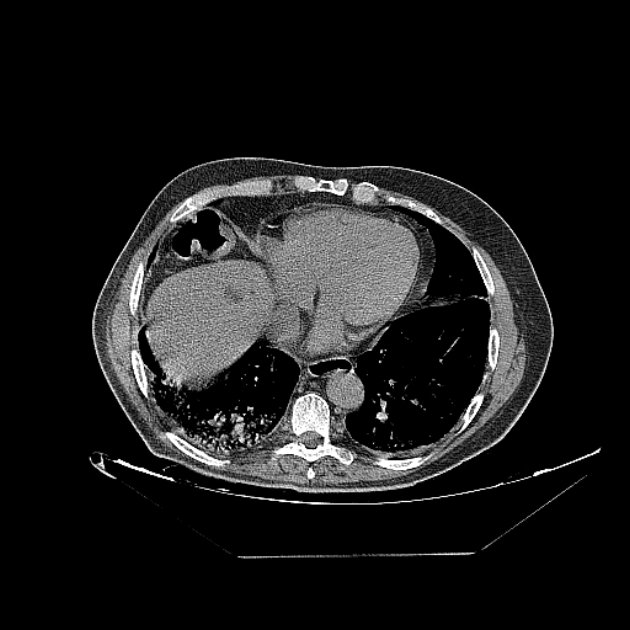 Cavitating bronchogenic carcinoma (Radiopaedia 44489-48162 Axial non-contrast 62).jpg