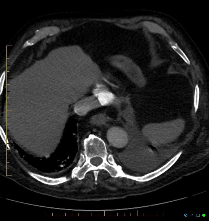 Cavitating pulmonary infarction (Radiopaedia 54634-60849 Axial C+ CTPA 70).jpg