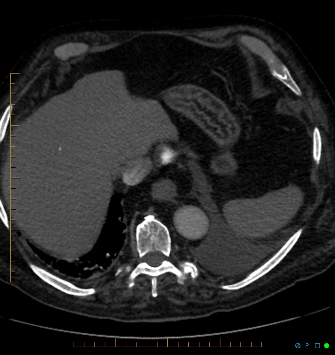 Cavitating pulmonary infarction (Radiopaedia 54634-60849 Axial C+ CTPA 72).jpg