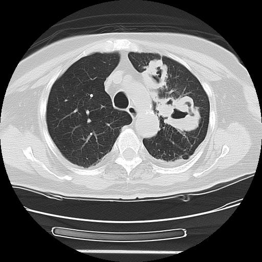 Cavitating pulmonary metastases (Radiopaedia 89545-106544 Axial lung window 17).jpg