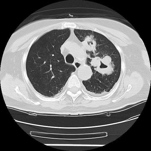 Cavitating pulmonary metastases (Radiopaedia 89545-106544 Axial lung window 18).jpg