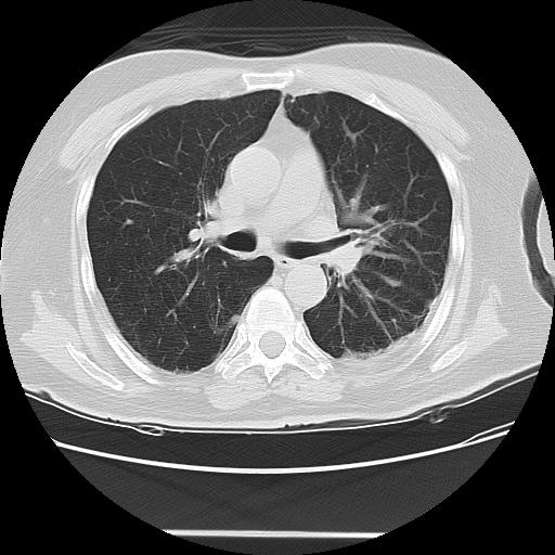 Cavitating pulmonary metastases (Radiopaedia 89545-106544 Axial lung window 25).jpg