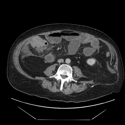 Cecal adenocarcinoma (Radiopaedia 64871-73817 A 56).jpg