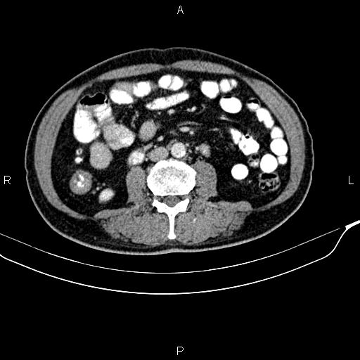 File:Cecal cancer with appendiceal mucocele (Radiopaedia 91080-108651 B 58).jpg