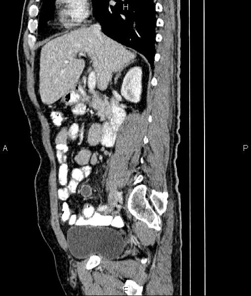 File:Cecal cancer with appendiceal mucocele (Radiopaedia 91080-108651 E 38).jpg
