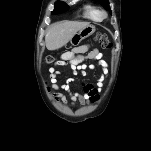 File:Cecal mass causing appendicitis (Radiopaedia 59207-66531 B 10).jpg