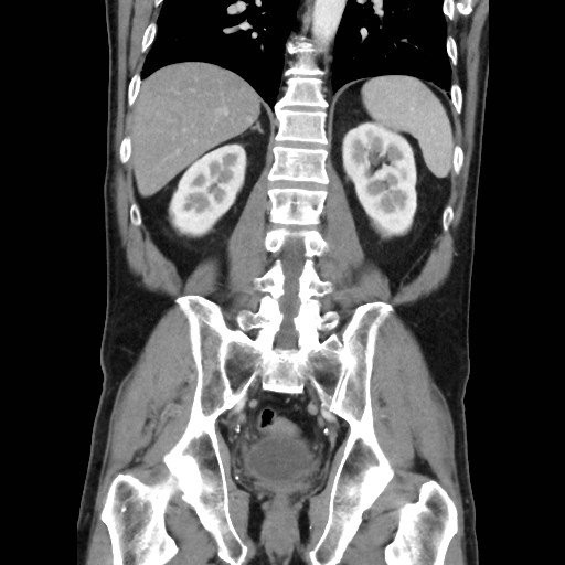 Cecal mass causing appendicitis (Radiopaedia 59207-66531 B 37).jpg