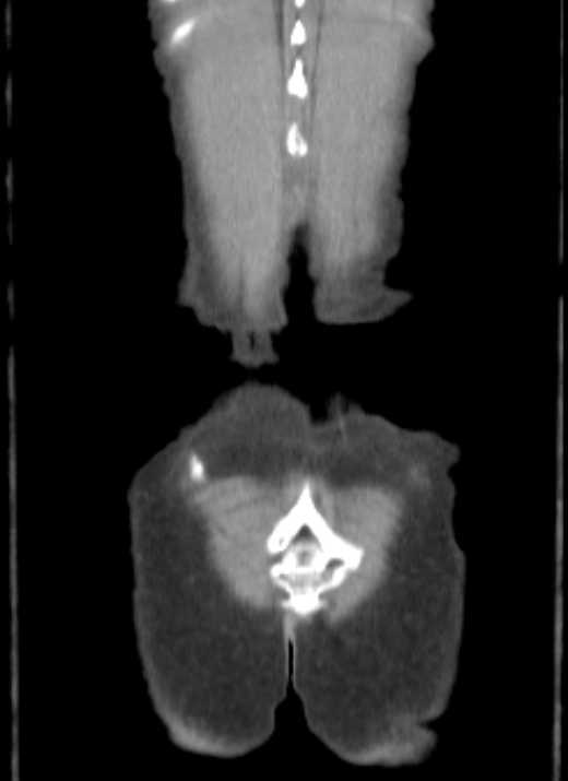 Cecal volvulus with pneumatosis coli (Radiopaedia 68572-78178 B 2).jpg