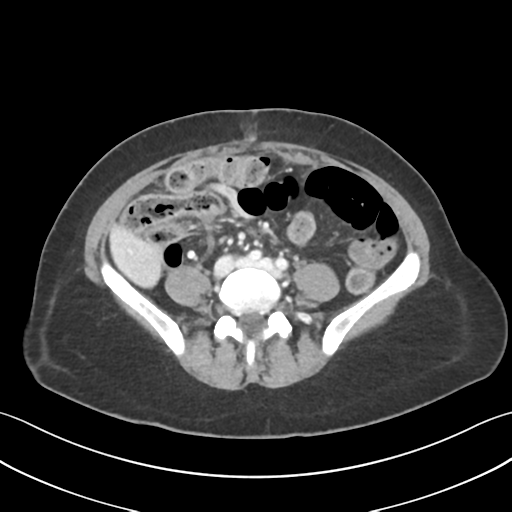 Cecum hernia through the foramen of Winslow (Radiopaedia 46634-51112 A 44).png