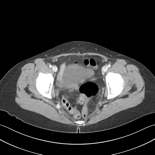 File:Cecum hernia through the foramen of Winslow (Radiopaedia 46634-51112 A 66).png