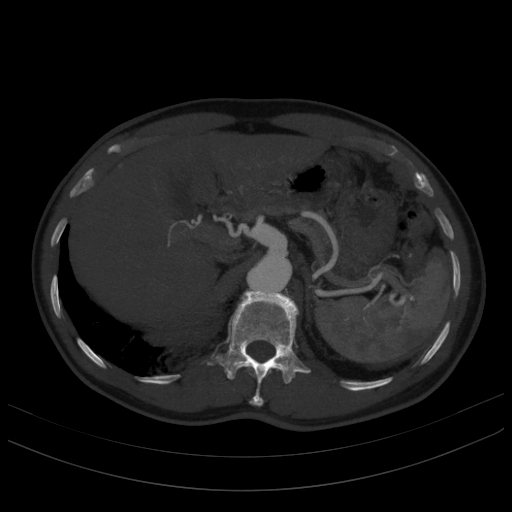 File:Celiac artery aneurysm (Radiopaedia 21574-21525 A 1).JPEG