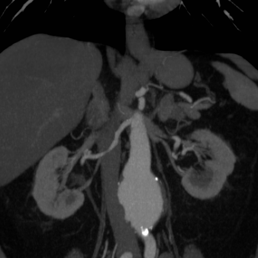 File:Celiac artery compression by the diaphragmatic crurae (Radiopaedia 31739-32666 B 6).jpg