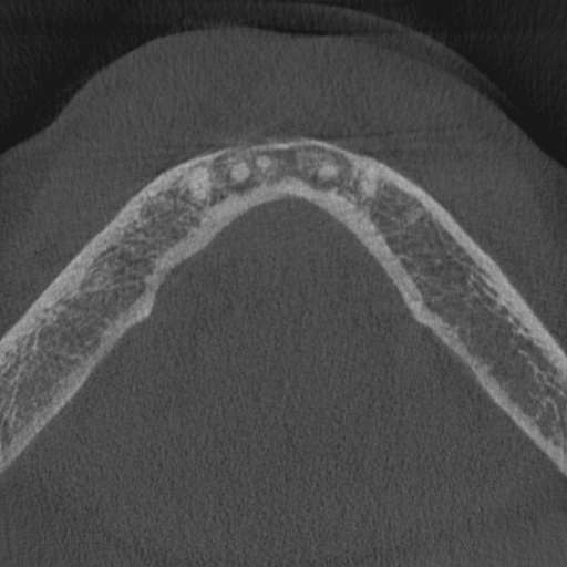File:Cemento-osseous dysplasia (Radiopaedia 48251-53126 Axial non-contrast 17).jpg