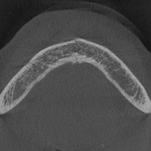 File:Cemento-osseous dysplasia (Radiopaedia 48251-53126 Axial non-contrast 3).jpg