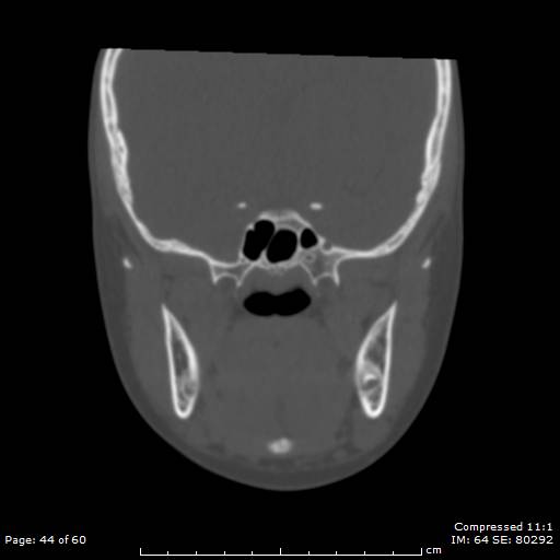 Central giant cell granuloma (Radiopaedia 45612-49754 Coronal bone window 44).jpg