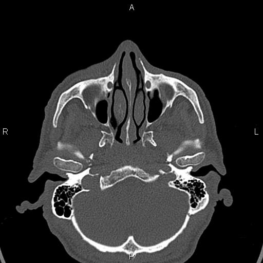 File:Central giant cell granuloma (Radiopaedia 83346-97761 Axial bone window 43).jpg