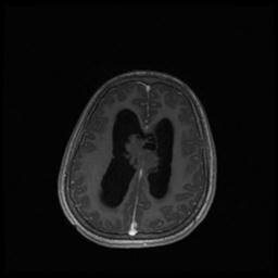 Central neurocytoma (Radiopaedia 30220-30842 Axial T1 C+ 105).jpg