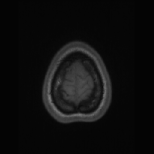 File:Central neurocytoma (Radiopaedia 37664-39557 Axial T1 69).png
