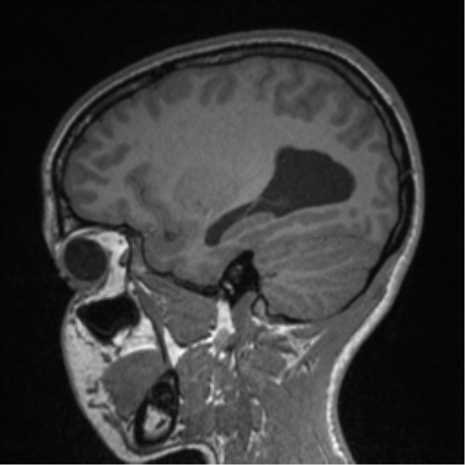 Central neurocytoma (Radiopaedia 37664-39557 Sagittal T1 30).png