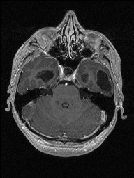 Central neurocytoma (Radiopaedia 56690-63469 Axial T1 C+ 47).jpg