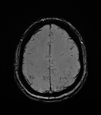 File:Central neurocytoma (Radiopaedia 71068-81303 Axial SWI 51).jpg